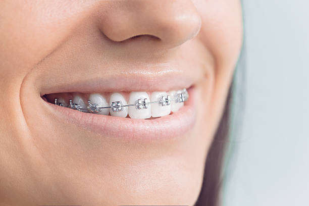 Dental Bonding in Fallston, MD